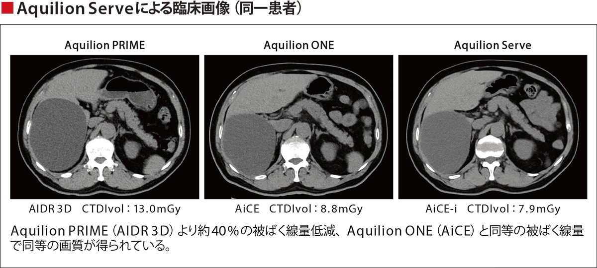 Aquilionerveによる臨床画像(同一患者)