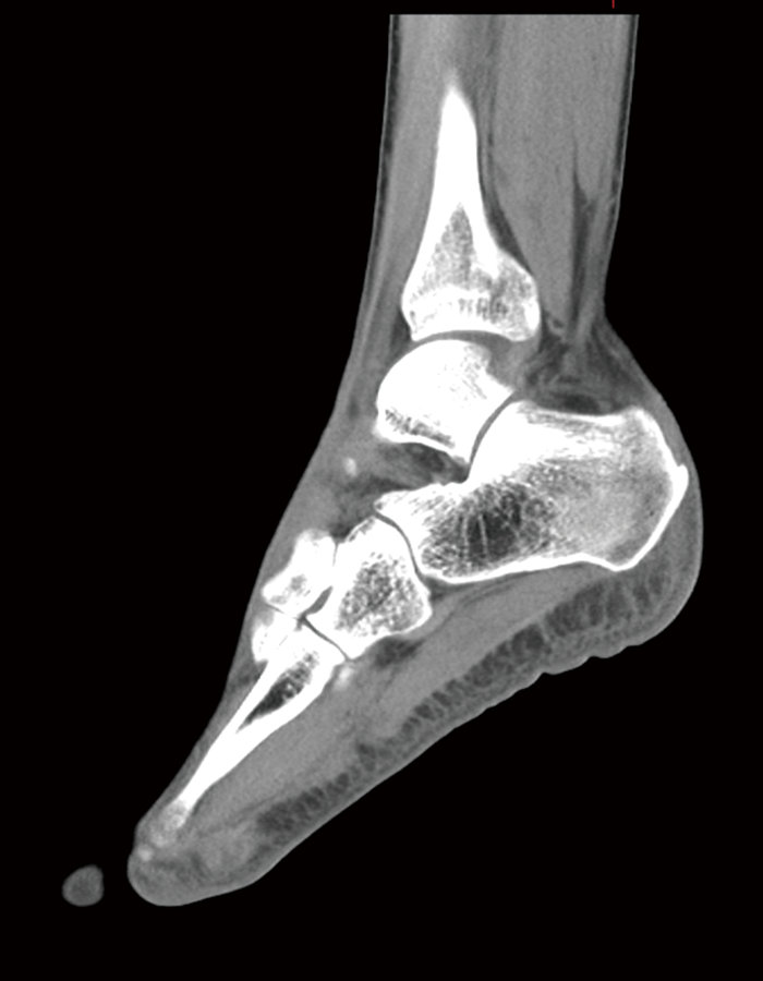 踵骨 Dual Energy撮影 骨条件