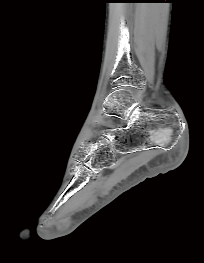 踵骨 Dual Energy撮影 VNCa