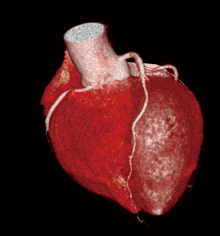 同一患者の冠動脈CT b