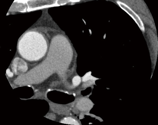同一患者の冠動脈CT a