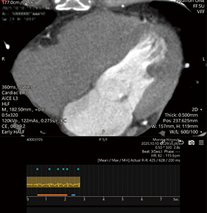 1ビートによるハーフ再構成