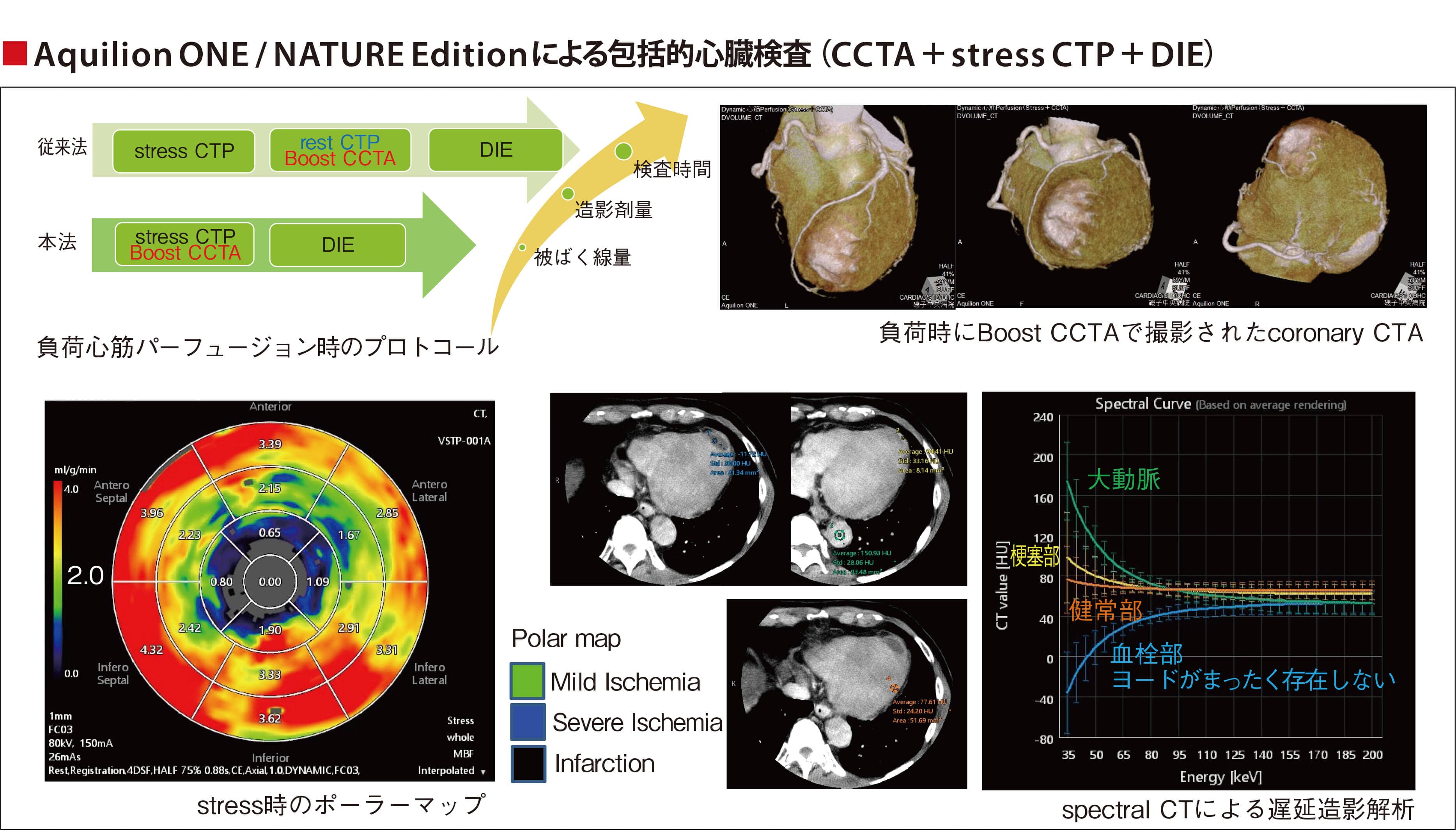 Aquilion ONE / NATURE Editionによる包括的心臓検査(CCTA+stress CTP+DIE)