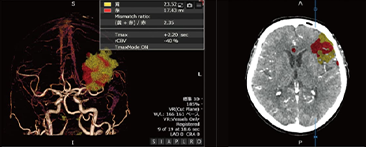 CT-PerfusionとVitrea導入の経緯の写真