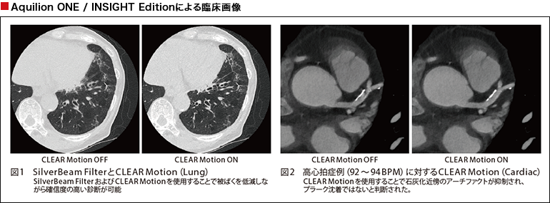 Aquilion ONE / INSIGHT Editionによる臨床画像