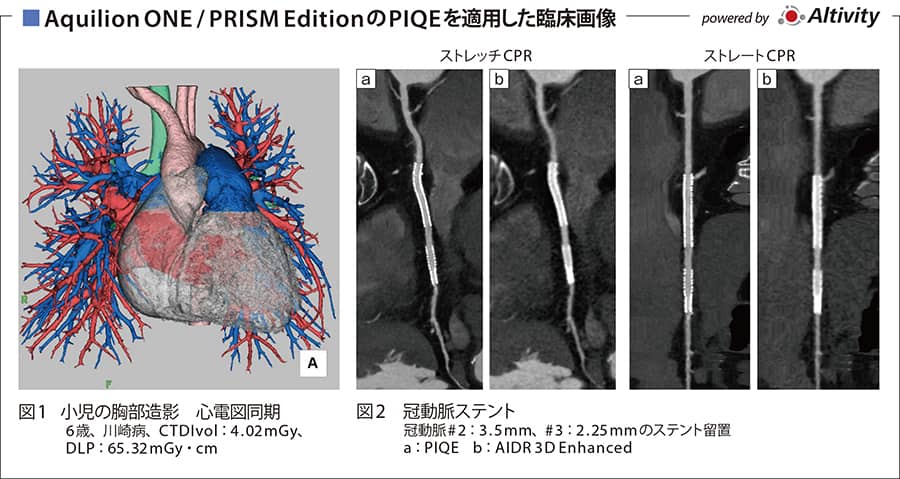 PIQEの適用で被ばく線量を半減し画質を維持した小児心臓CT検査を