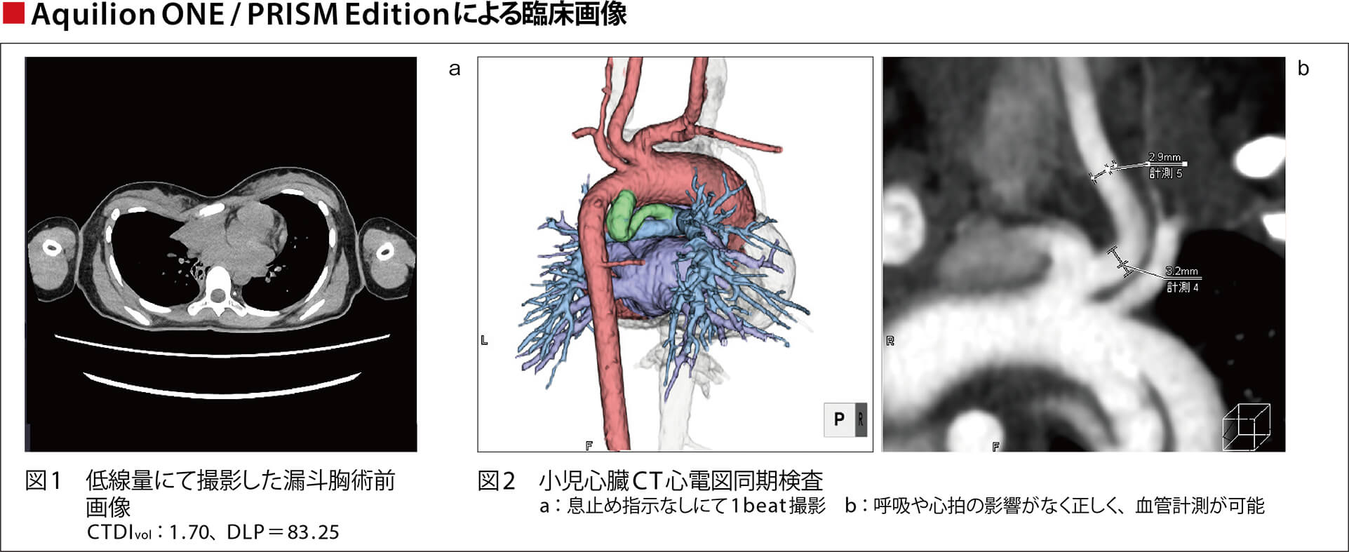面検出器による高速撮影と高画質・低被ばくの小児心臓CTを術前