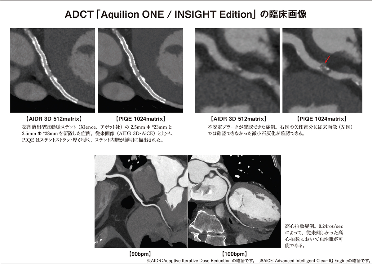 ADCT「Aquilion ONE / INSIGHT Edition」の臨床画像