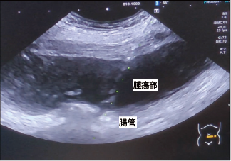 超音波ガイド下生検（卵巣がん：腹膜播種病変）