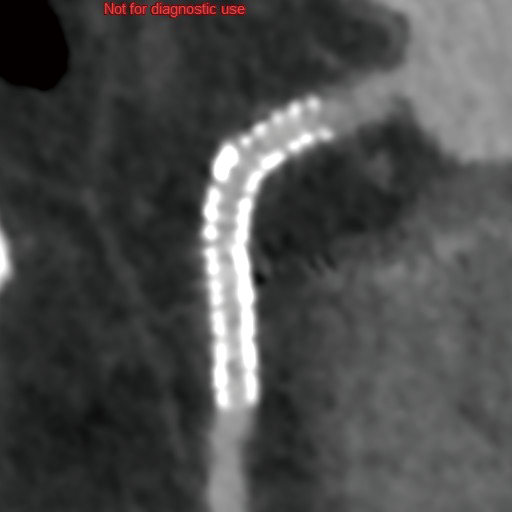 3.5mm Stent 2024