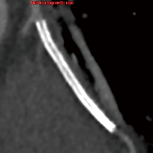 2.25mm Stent 2024