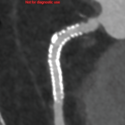 3.5mm Stent 2025