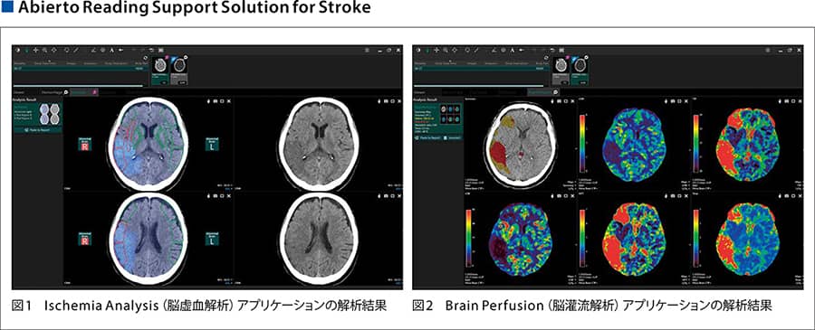 Abierto Reading Support Solution for Stroke, 図1 Ischemia Analysis(脳虚血解析)アプリケーションの解析結果, 図2 Brain Perfusion(脳灌流解析)アプリケーションの解析結果