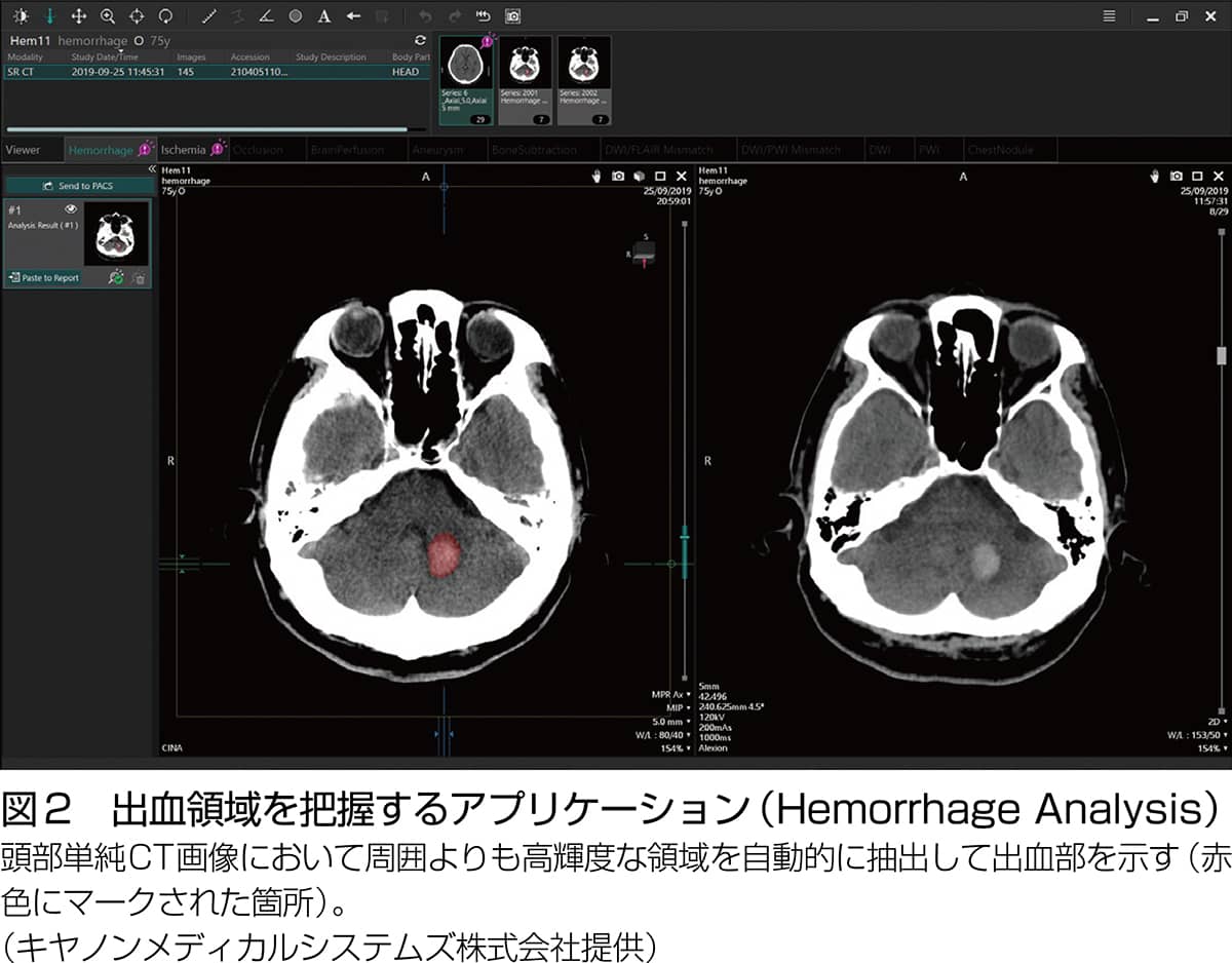 図2 出血領域を把握するアプリケーション (Hemorrhage Analysis)