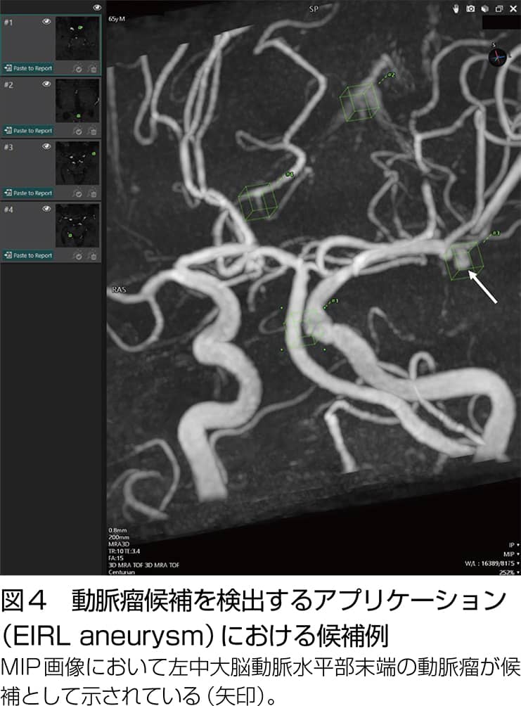 図4 動脈瘤候補を検出するアプリケーション (EIRL aneurysm)における候補例