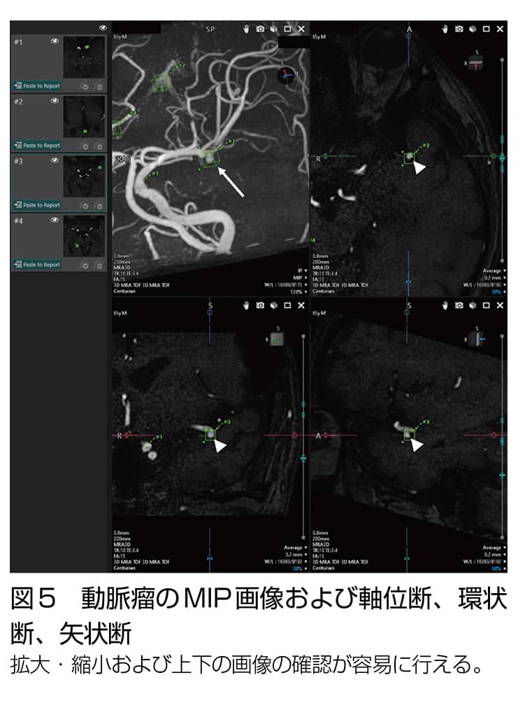 図5 動脈瘤のMIP画像および軸位断、環状断、矢状断