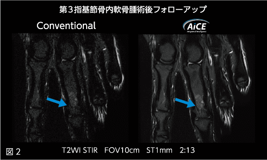 図2 第３指基節骨内軟骨腫術後フォローアップ