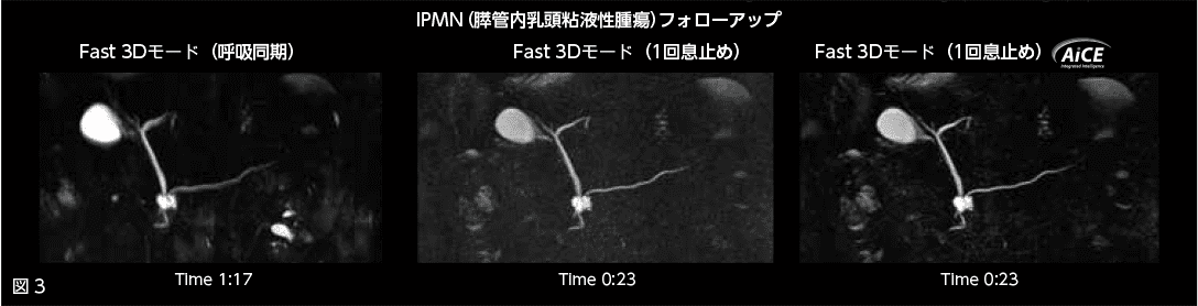 図3 IPMN(膵管内乳頭粘液性腫瘍)フォローアップ