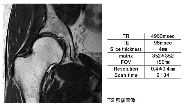 T2強調画像
