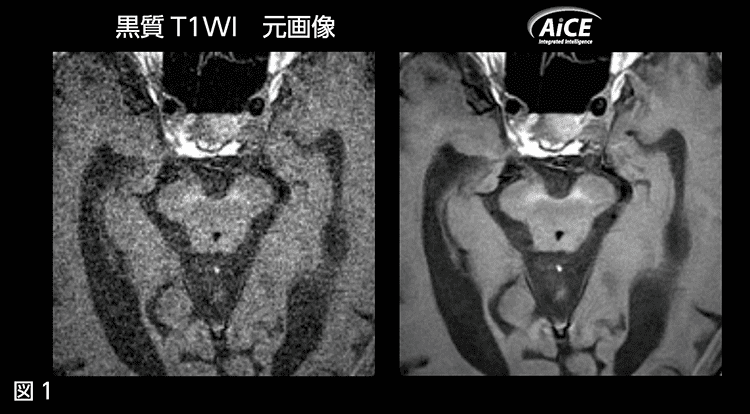 図1 黒室T1WI 元画像