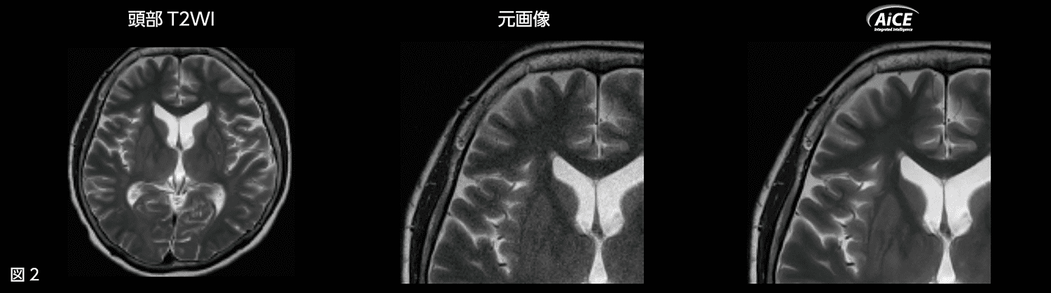 図2 頭部T2WI 元画像