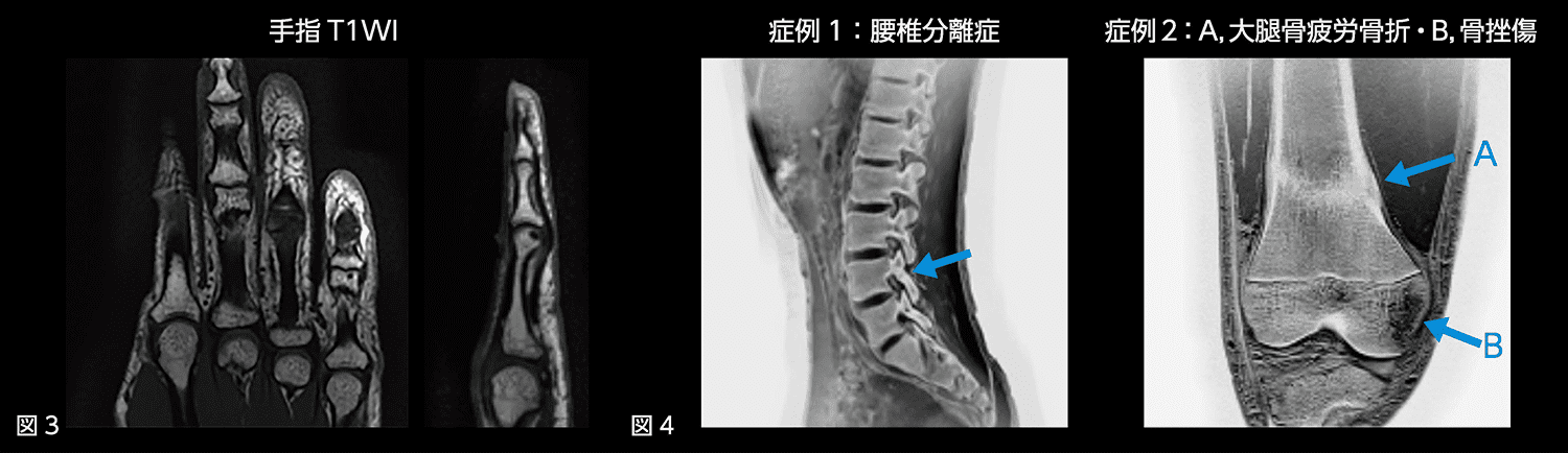 図3 手指T2WI, 図4 症例1・2