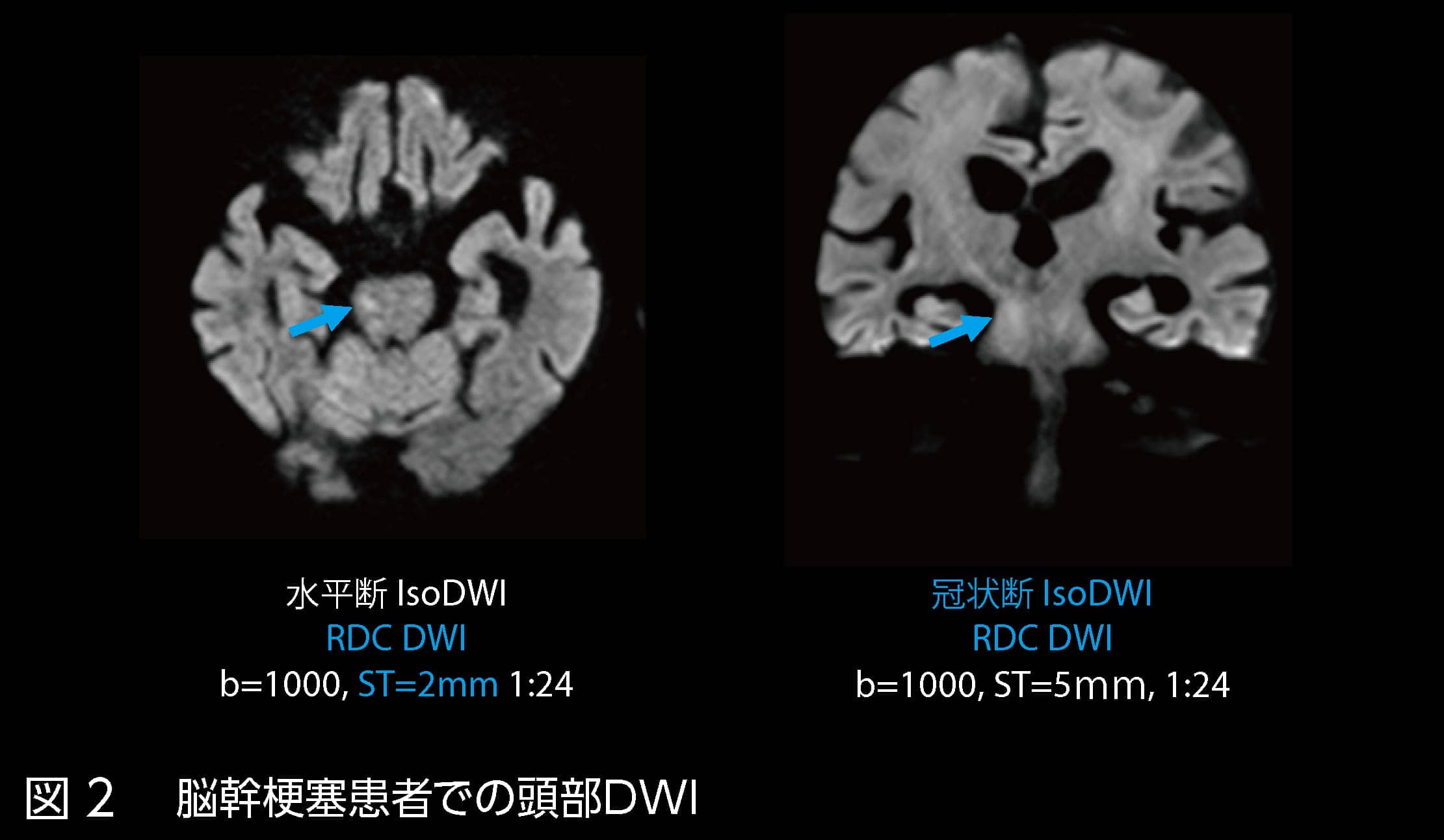 図2 脳幹梗塞患者での頭部DWI