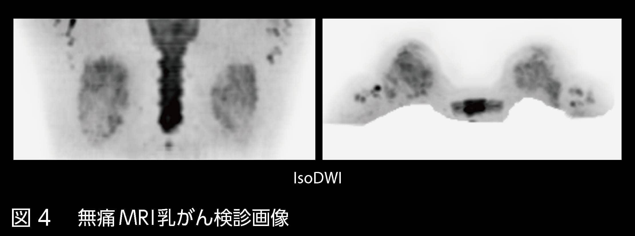 図4 無痛MRI乳がん検診画像