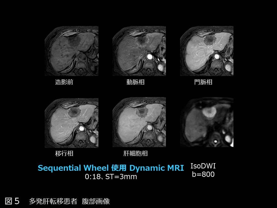 図5 多発肝転移患者 腹部画像