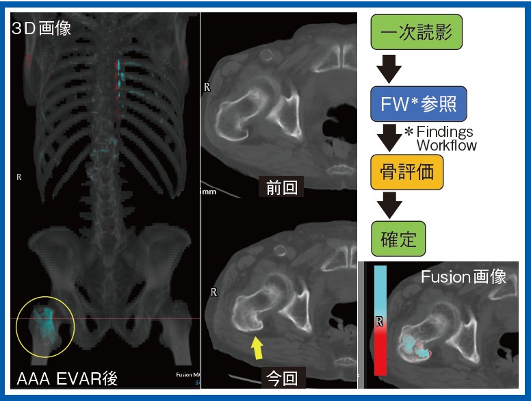図5　症例5：80歳代、男性、AAAのEVAR後、大腿骨骨折
