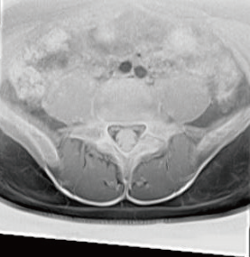 図2 Bone Image（腰椎分離症）