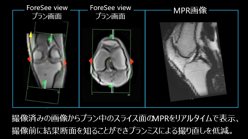 Fig.3 膝関節にForeSee Viewを応用した例
