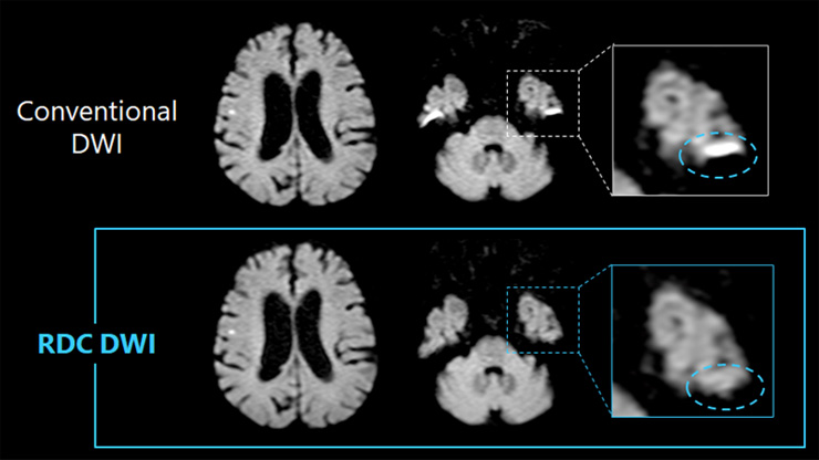 Fig.4 頭部ルーチン内で使用しているRDC DWI