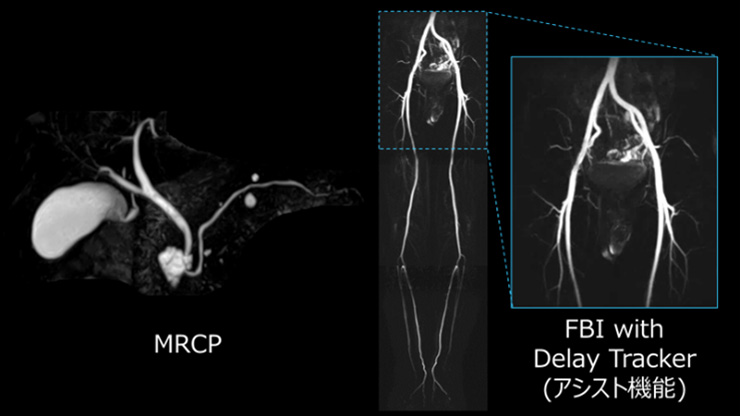 Fig.5 MRCPとFBIの画像