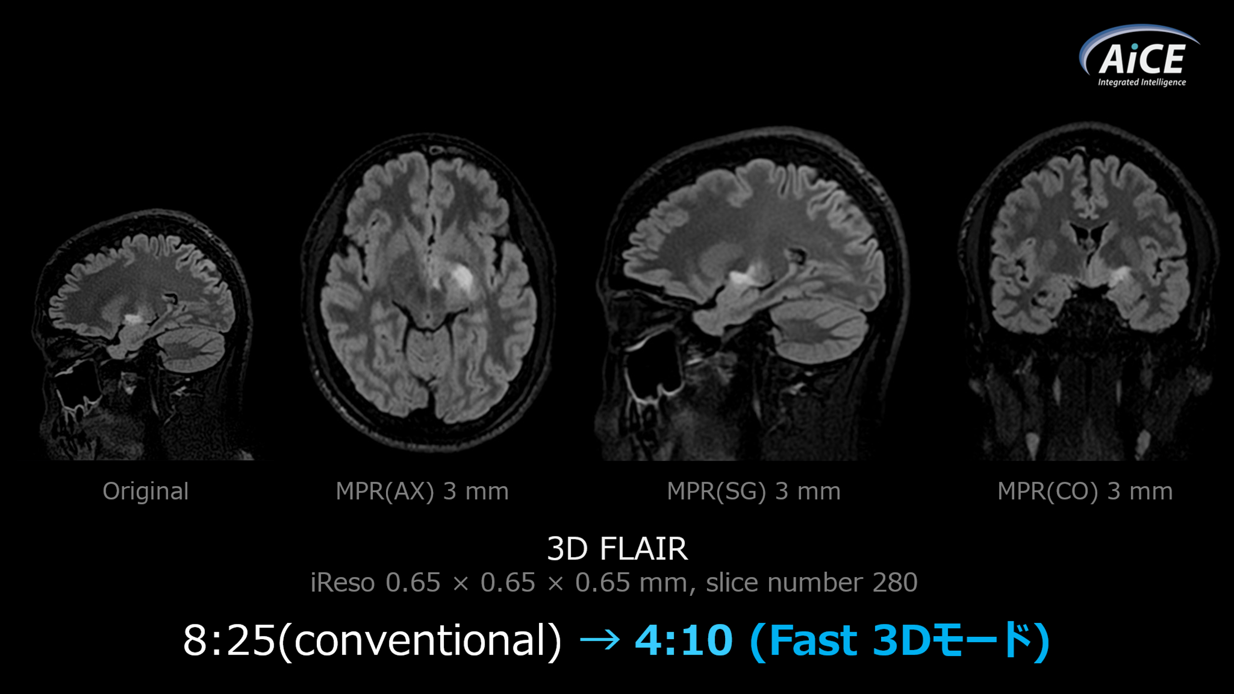 Fig.4. 3D FLAIRにExsperとFast 3Dモードを使用した画像