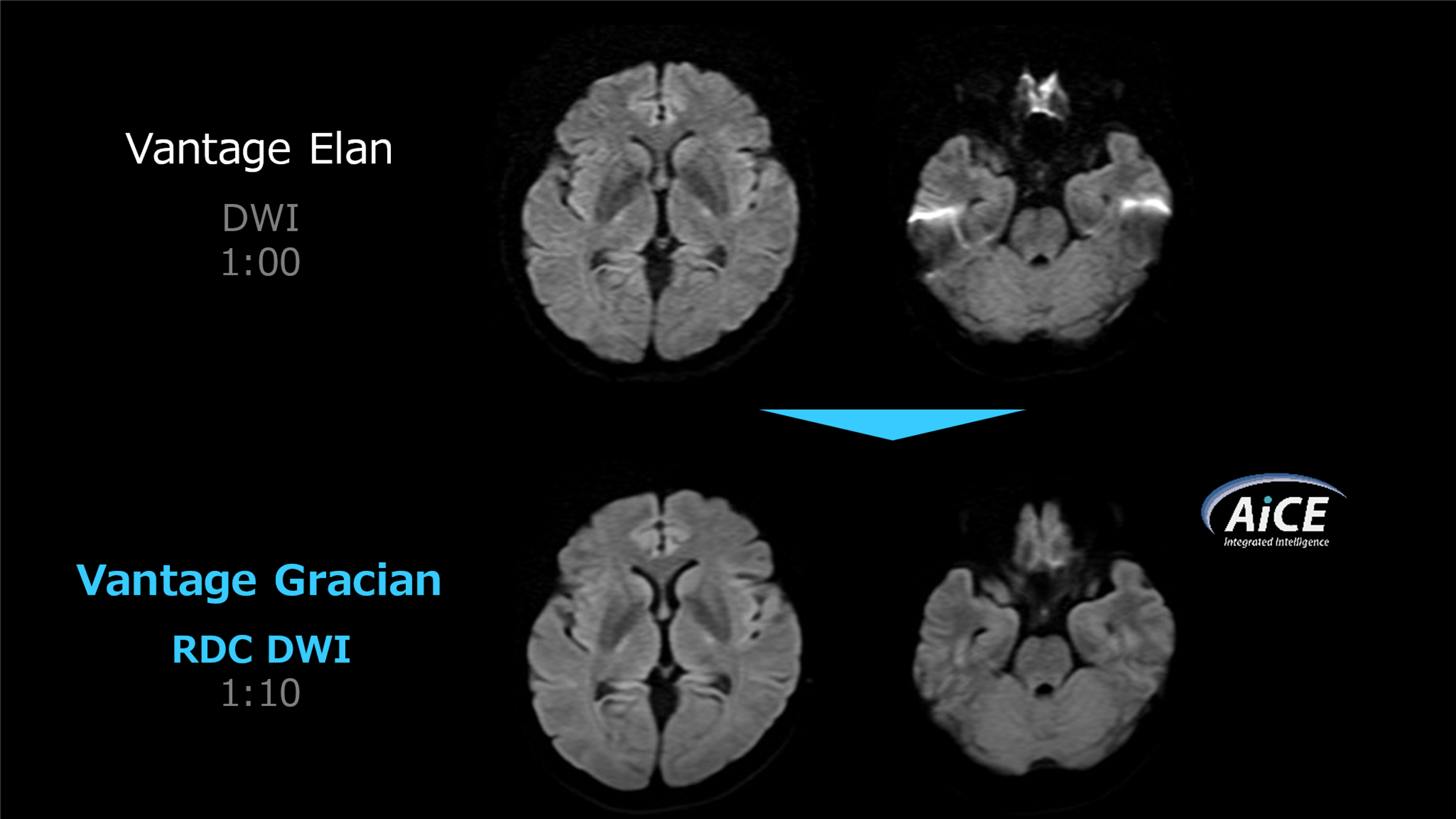 Fig.5. RDC DWIの使用前後の同一患者の画像