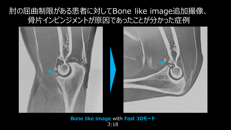 Fig.4 Bone like imageが有用であった例