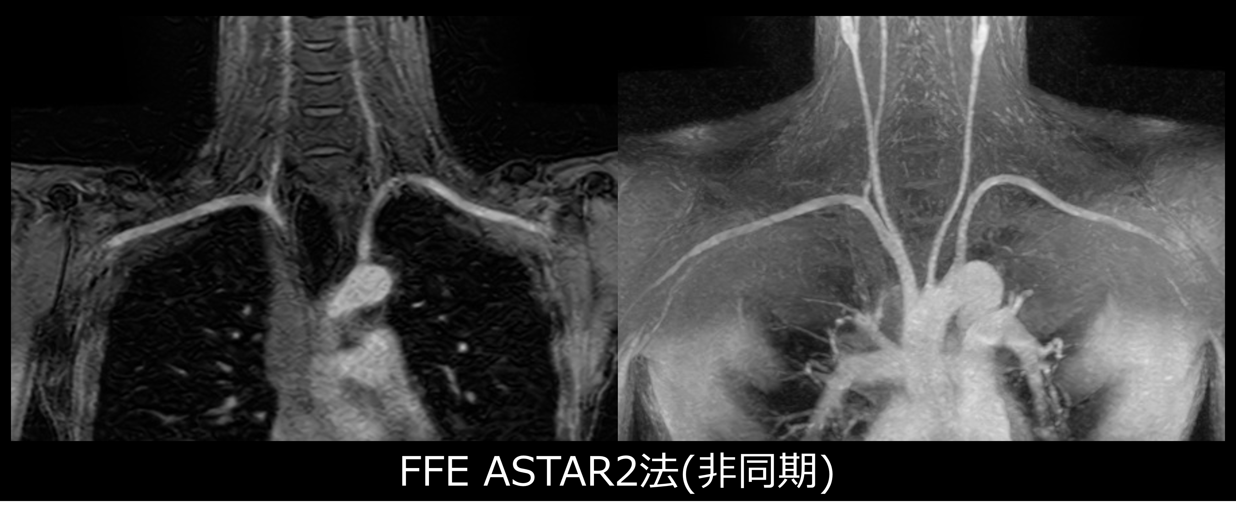 非造影鎖骨下動脈撮像
