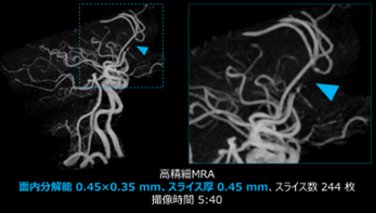Fast3DモードとAiCEを併用した高精細MRA