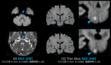 RDC DWIによる歪みを低減したDWI