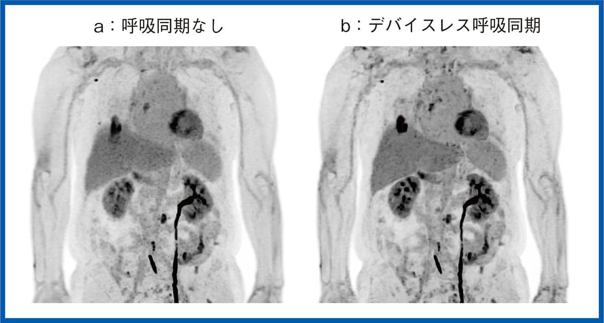 デバイスレス呼吸同期の適用画像