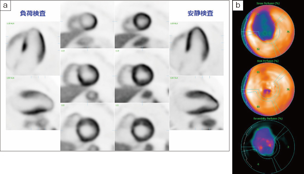 図1　心臓アンモニアPET