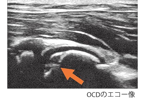 OCDのエコー像の写真