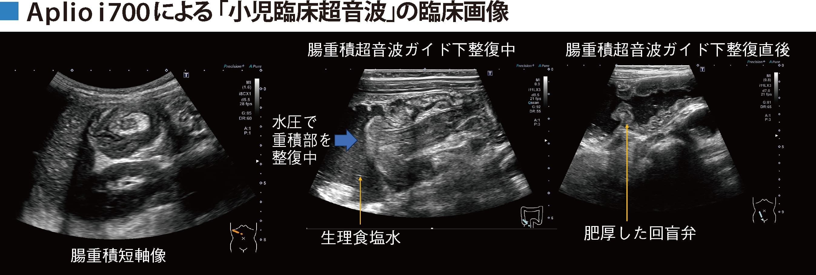 図1　腸重積の超音波ガイド下整復（画論26th The Best Image優秀賞）　画像