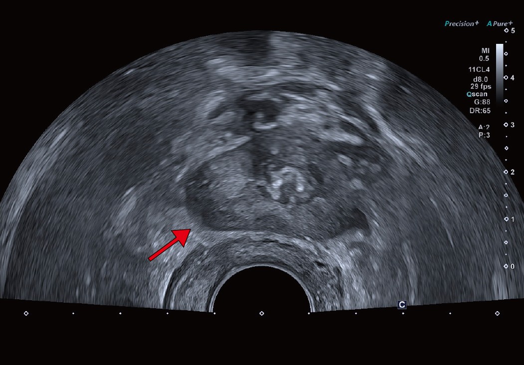 a：経直腸超音波画像。前立腺右葉辺縁領域に低エコー領域を認めるが、がんとは断定しづらい。