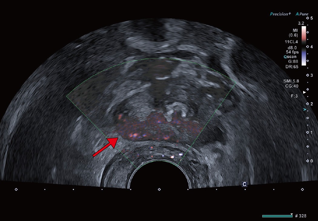 b：前立腺右葉辺縁領域に明らかなSMI陽性像、すなわち微小血管が描出されており、同部位からGS4+4が検出されている。