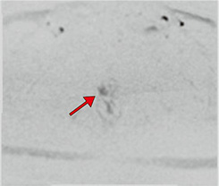 c：前立腺右葉辺縁領域にPI-RADS 4の病変を認める。