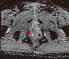 d：cと合致した部位にADCにてPI-RADS 4病変を認める。cの部位とbの画像でSMI陽性の病変は一致している。