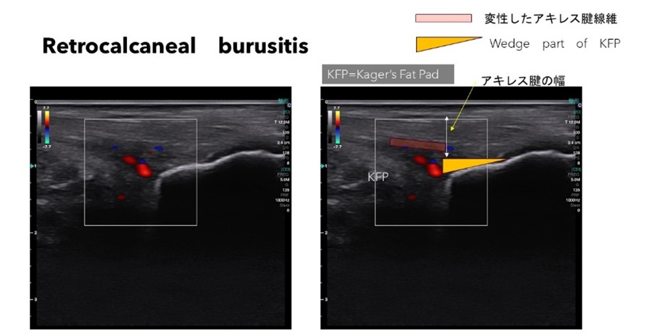 図1　アキレス腱　Bursa内に滑液の貯留と滑膜増生に伴う血管を反映するカラードプラー信号が観察される