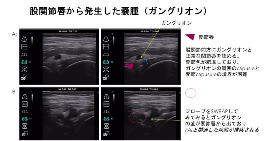 図1　大腿四頭筋のセッティングによるエコーガイド下膝関節注射